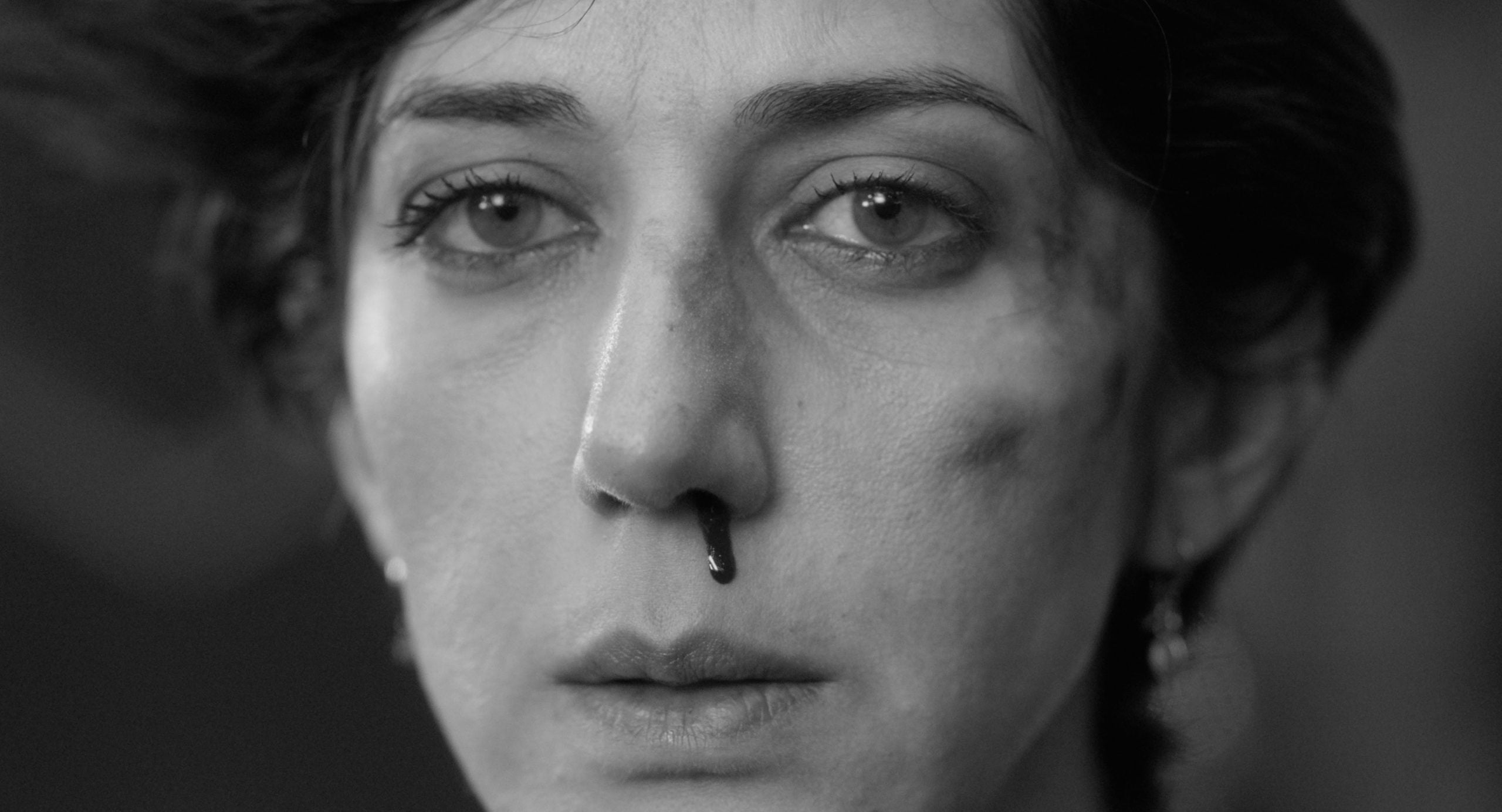 A close-up of a person with a nosebleed and visible bruising on their face, looking straight ahead with a neutral expression. The image is in black and white.